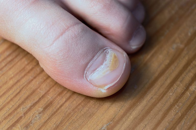 disturbing appearance of nails - muehrcke strand