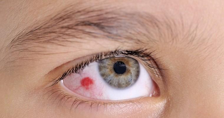 roter Fleck auf dem Weiß des Auges