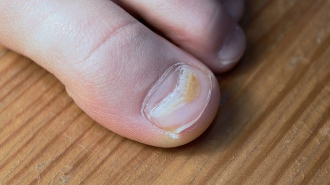 Zmiany na paznokciach u nóg – co oznaczają?