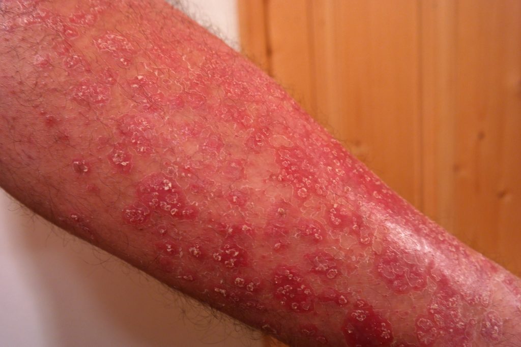 łuszczyca - choroba skóry