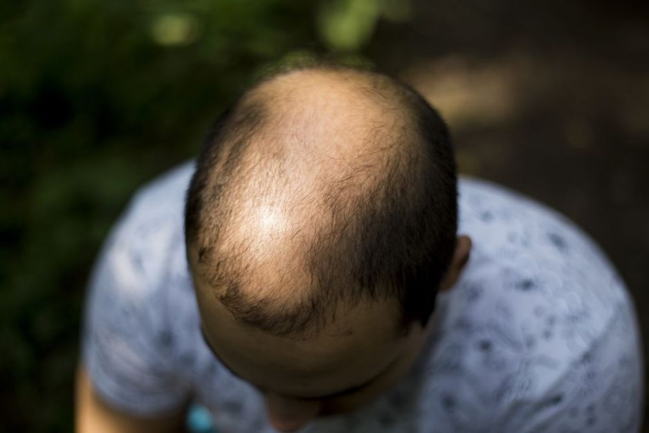 baldness in men